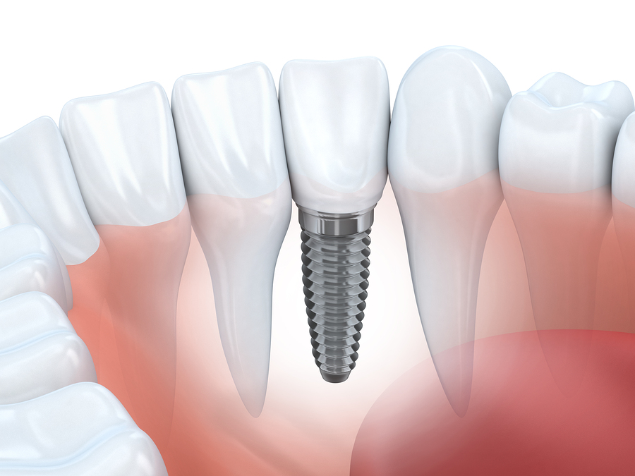 illustration of dental implant in jaw with natural teeth, Implant Dentistry Kearney, NE